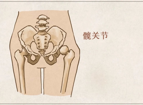 髋关节置换的那些事儿